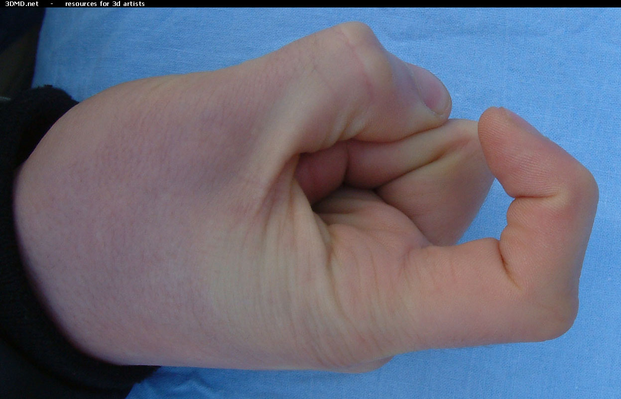 Male Forefinger Bent Left     